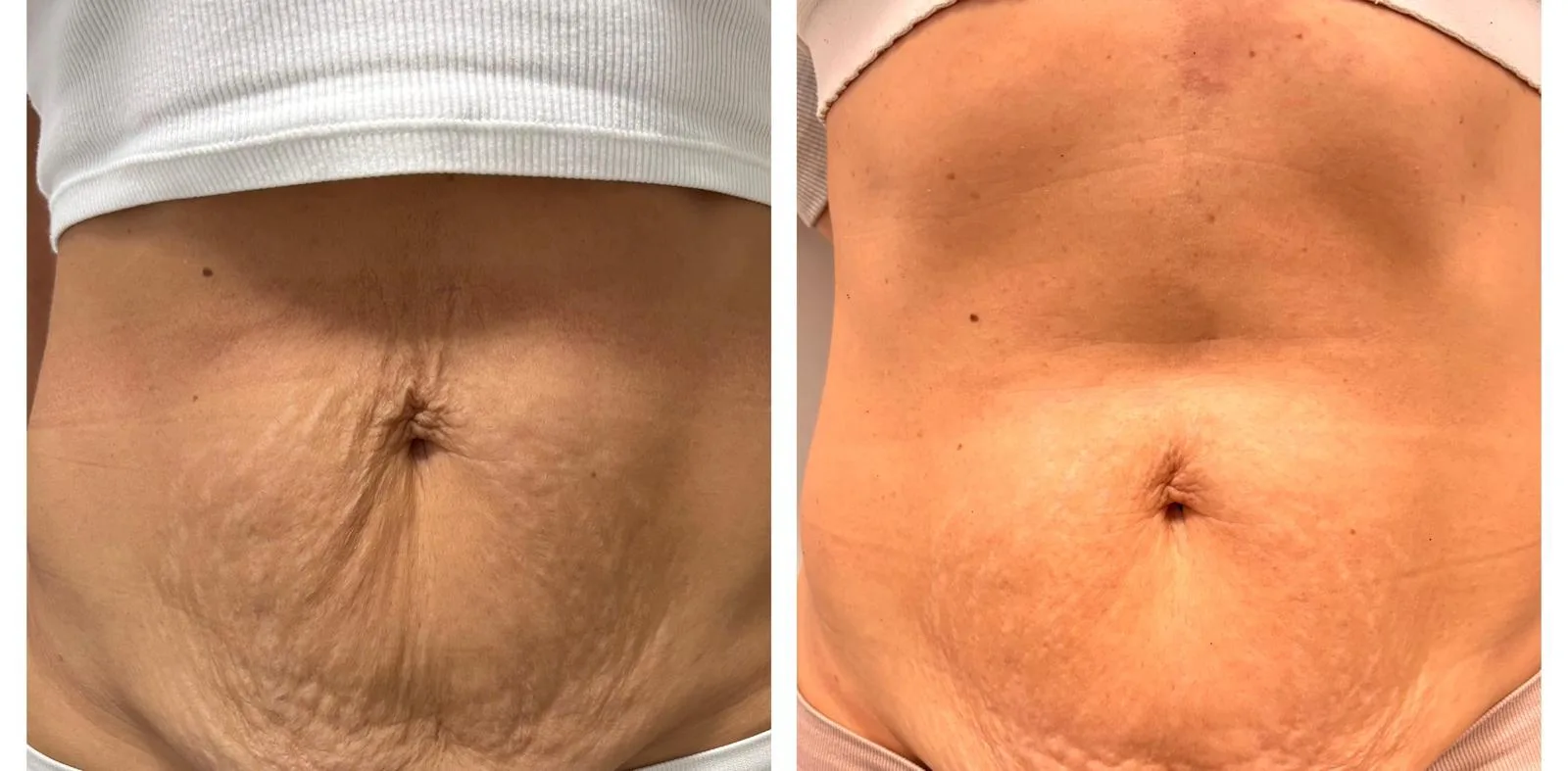 Antes y después de un bono de RSP-Tonic en el abdomen: la piel queda más firme