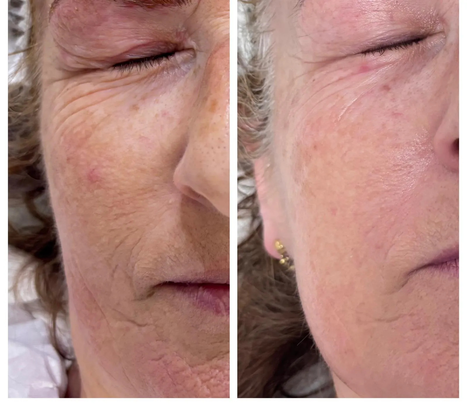 Antes y después de un tratamiento facial regenerador: piel más lisa y luminosa