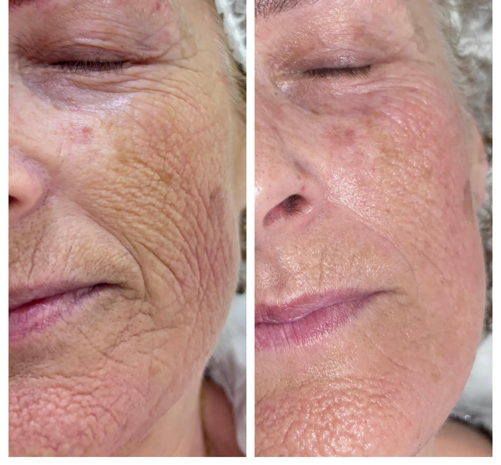 Antes y después reales de un tratamiento facial regenerador en la mejilla de una clienta del centro